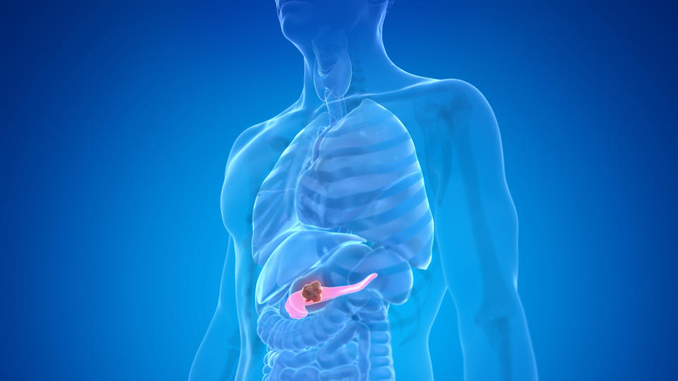 Pancreas cancer, illustration.Symptoms of pancreatic cancer are often vague. (Getty Images)