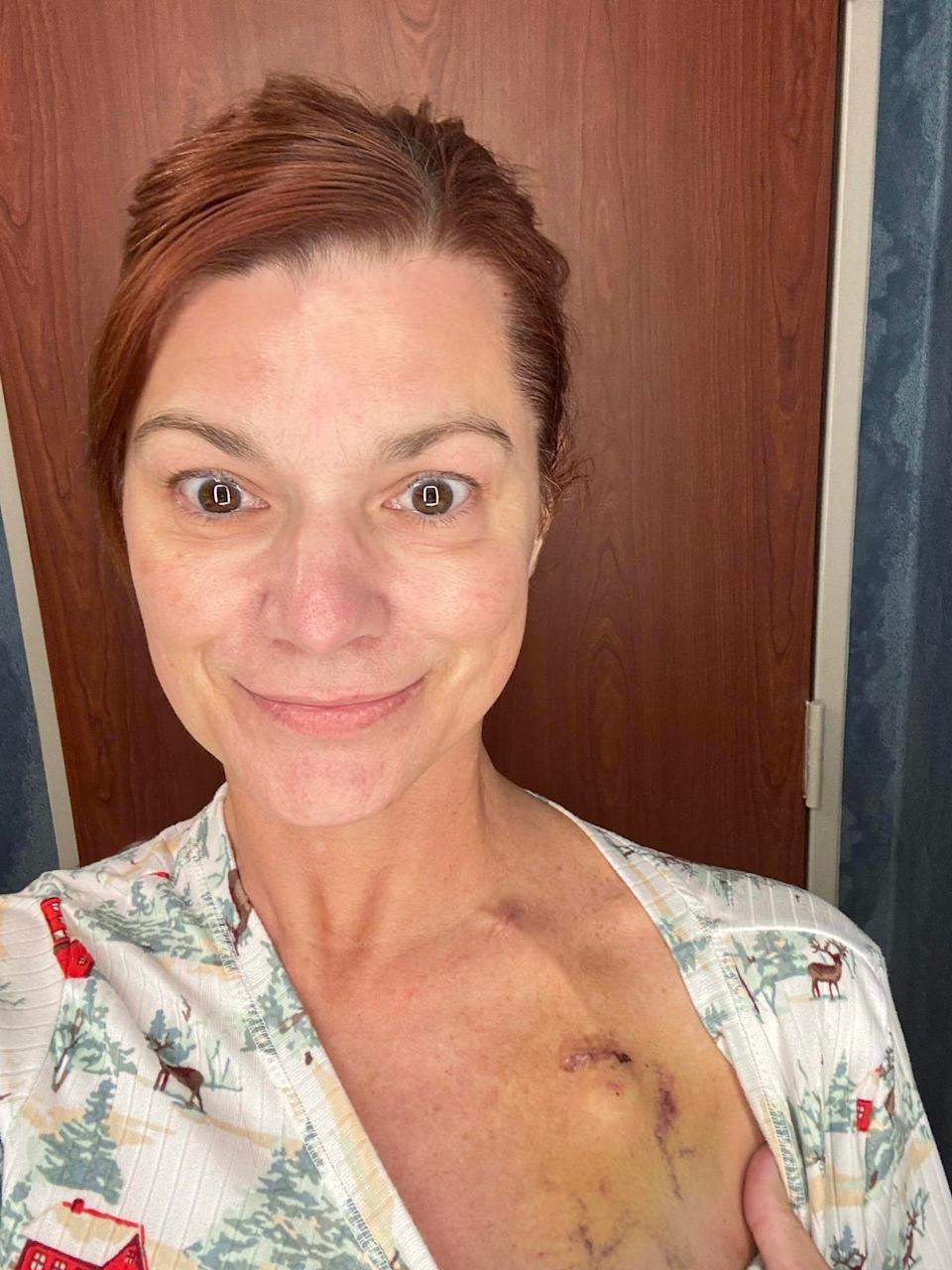 Francine Gauthier has shared real-life updates on her social media pages, including her chemotherapy port placement. (Courtesy Francine Gauthier)